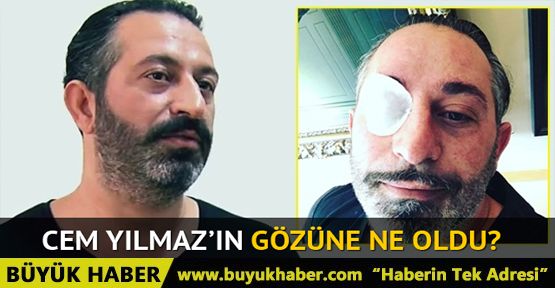 Cem Yılmaz'ın gözüne ne oldu?