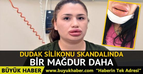 Dudak silikonu faciasında yeni mağdur çıktı