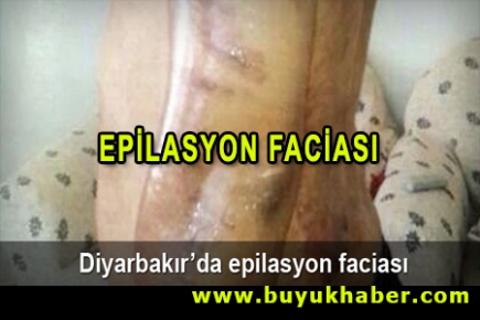 Epilasyon işkencesi